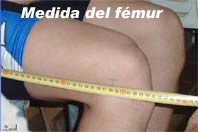 medida-de-femur_imagen6