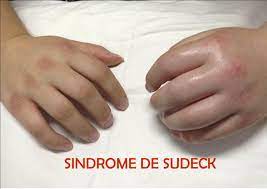 Aplicación de tratamiento rehabilitador a pacientes con Sudeck en el policlínico 14 de junio.